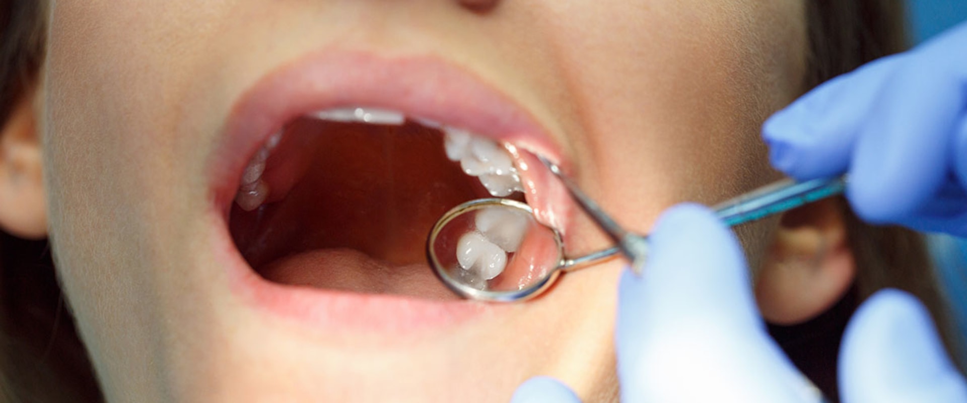 What is the Average Cost of Invisalign Treatment at a Dentist in Fairhope, Alabama?