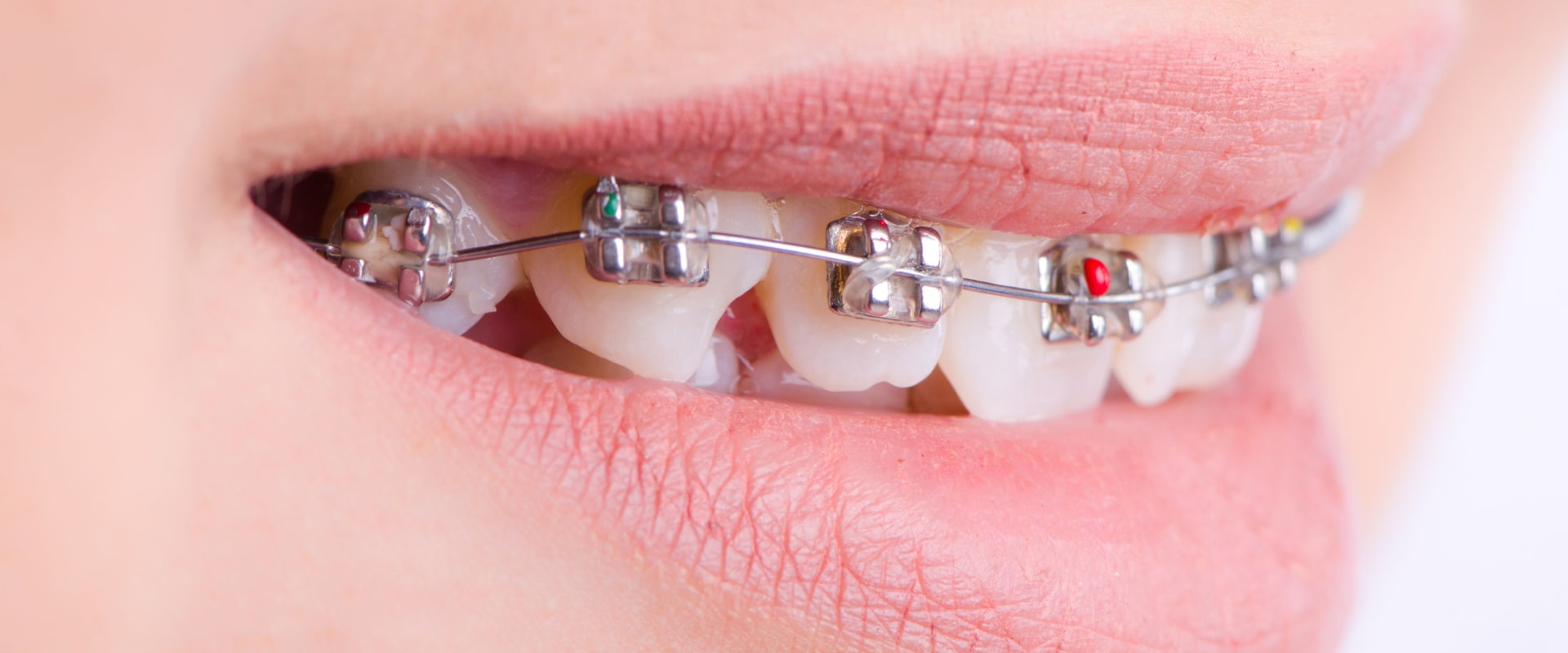 What is the Cost of Braces at a Dentist in Fairhope, Alabama?